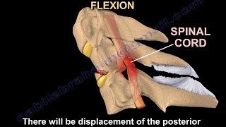 Tear Drop Fracture of the cervical spine  Everything You Need To Know  Dr Nabil Ebraheim [upl. by Vernon]