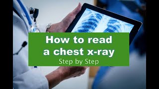 02 Chest xray cases CT scan and MRI [upl. by Ahsier563]