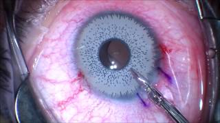 Want to change your eye color Think twice Iris Implant Removal JT Kavanagh MD San Antonio TX [upl. by Baily]