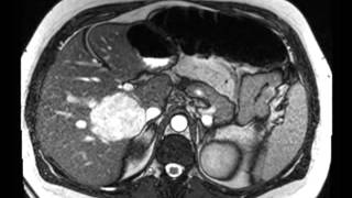 Liver Hemangioma [upl. by Citron]