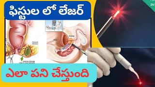 లేజర్స్ in FISTULA IN ANOKSHARA SUTRA [upl. by Anitnatsnoc]