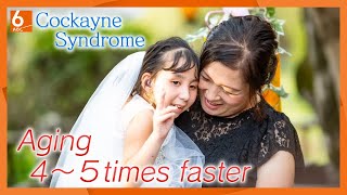 A 14 year old girl in the body of a 4 year old Aging 4 to 5 times faster due to Cockayne Syndrome． [upl. by Gibby]