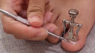 Best Toenail Clippers for Thick and Ingrown Nails 2020 [upl. by Idnaj]