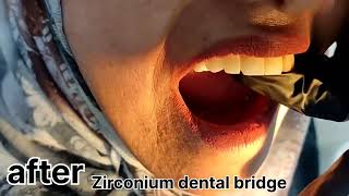 zirconia crowns dental bridge before and after [upl. by Thant476]