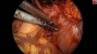 VATS Left pneumonectomyProgress under neoadjuvant therapy [upl. by Joyan]