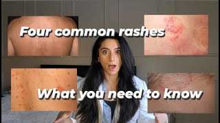 Four common rashes and everything you need to know about them [upl. by Nosduh]