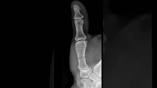 First metacarpal midshaft fracture virlshorts [upl. by Teak]