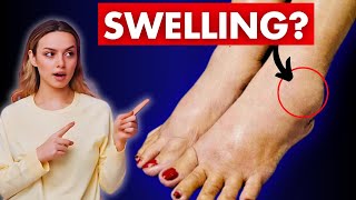 1 VITAMIN to Eliminate Swollen Legs and Ankles Fast Edema [upl. by Ahgiela]