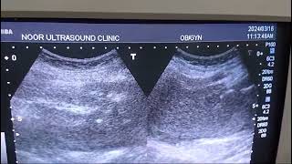 ultrasound abdomenPsoas abscess [upl. by Budwig255]