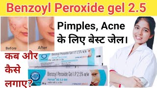 Persol AC 25 GEL  Pimple Acne ka ilaj  Benzoyl peroxide gel  DrxPranjali Satpute [upl. by Tannenbaum]