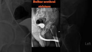 RGU  Retrograde urethrogram  Bulbar urethral stricture shorts rgu radiology specialcase [upl. by Noraa516]