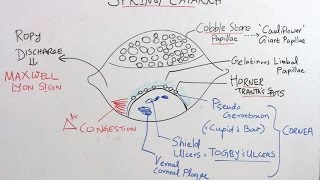 High Yield Topic Vernal Kerato Conjunctivitis amp Trachoma [upl. by Latsyrcal]