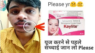 Keylite cream review  Fairness cream side effect  skin whitening cream side effects  side effect [upl. by Rehtul]