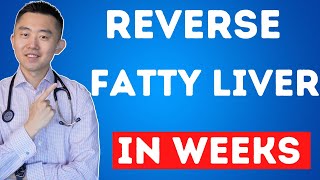 The FASTEST Way to Reverse Fatty Liver Naturally  NAFLD Treatment [upl. by Sremlahc]