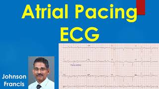 Atrial Pacing ECG [upl. by Jephthah]