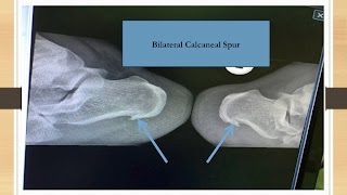 Bilateral Calcaneal Spur [upl. by Eniamrehs]