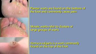 What are Foot Warts and How To Treat Them [upl. by Seidel]