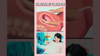 Removal of placenta fetalmovement bodypart baby cutebaby shorts [upl. by Rayshell]