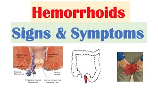 Hemorrhoids Signs amp Symptoms  Internal vs External Hemorrhoid Symptoms  Hemorrhoidal Disease [upl. by Niwhsa190]