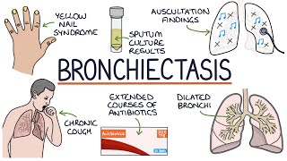 Understanding Bronchiectasis [upl. by Harday107]