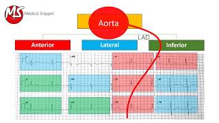 ECG localisation of the occluded coronary artery Myocardial Infarction [upl. by Oirromed597]