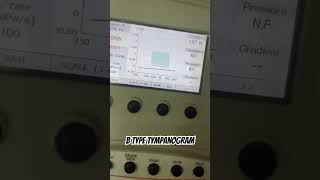 Tympanometry B type tympanogram audiology tympanicmembraneperforation [upl. by Selokcin779]