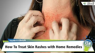 How To Treat Skin Rashes with Home Remedies  ISH News [upl. by Eugaet43]