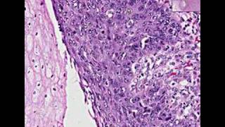 Histopathology EsophagusSquamous cell carcinoma [upl. by Sweeney]