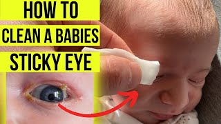 How to treat a STICKY EYE in babies including eyelid hygiene cleaning amp tear duct massage [upl. by Frazier543]