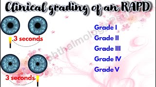 Pupil 4  Clinical grading of an RAPD  Marcus Gunn Pupil [upl. by Noelopan519]