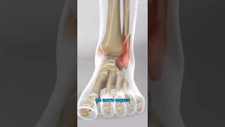 Ankle Fracture Surgery 3D Animation [upl. by Layney483]