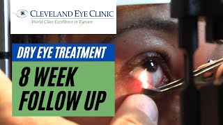 Dry eyes treatment does TearCare work 8week follow up with a real patient [upl. by Ali28]