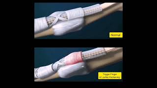 Trigger finger  a unique Ultrasound feature [upl. by Bezanson685]