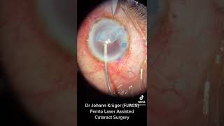 2023 Cataract Surgery with Laser Dr Johann Krüger performing Femto Laser Cataract Surgery [upl. by Aceber79]