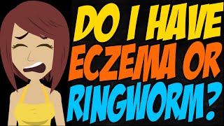 Do I Have Eczema or Ringworm [upl. by Oileve]