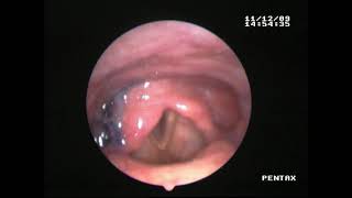 FEESUntersuchung ZenkerDivertikel vs Reflux [upl. by Eirek]