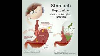 Peptic Ulcer Disease [upl. by Carolus]