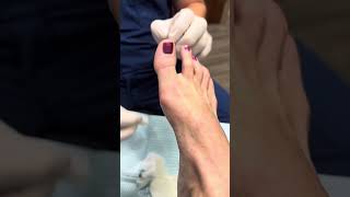 Aspiration of a cyst in the foot [upl. by Amled]