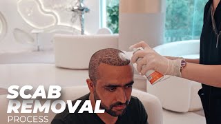 Scab Removal Process After Hair Transplantation [upl. by Garihc]