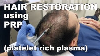 Scalp Hair Restoration using Platelet Rich Plasma  West End Plastic Surgery [upl. by Anet]