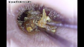 Ear Wax Removal 37  Clean Wet Earwax  Ear Cleaning ASMR [upl. by Marc]