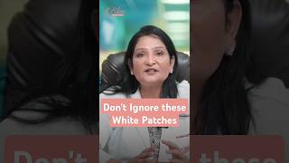 White patces on skin  Post Inflammatory Hypopigmentation  Best Pigmentation Treatment in Ludhiana [upl. by Cutcliffe337]