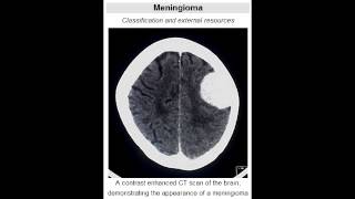 Meningioma  Second Most Common Primary Brain Tumor [upl. by Shutz]