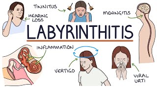 Understanding Labyrinthitis [upl. by Albion]