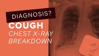 Chest XRay breakdown assessing a film with pleural plaques [upl. by Sybyl]