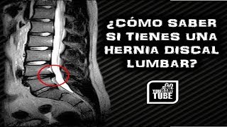 COMO SABER SI TIENES UNA HERNIA DISCAL LUMBAR  SIGNOS Y DIAGNOSTICO DE UNA HERNIA DISCAL [upl. by Mayworm]