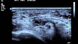 intermetatarsal bursa ultrasoundavi [upl. by Dhiren]