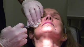 Injection of Botulinum Toxin for Treatment of Perioral Rhytids by Dr Z Paul Lorenc [upl. by Analad]