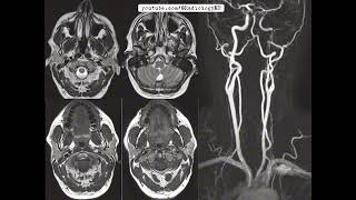 Case 98 with Horners syndrome [upl. by Leor877]