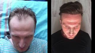 HAIR TRANSPLANT With 4360 Grafts Manual FUE  Two Surgeries Sessions at a Difference of 8 Years [upl. by Nosnhoj]